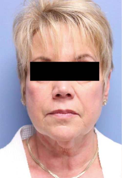 Face Lift Results St. Louis