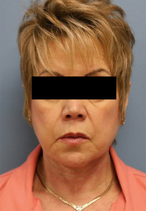 Face Lift Results St. Louis