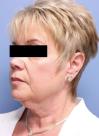 Face & Neck Lift