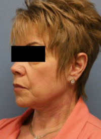 Face & Neck Lift