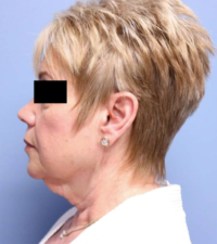 Face & Neck Lift