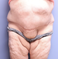 Panniculectomy