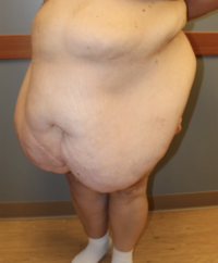 Panniculectomy