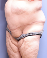 Panniculectomy