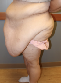 Panniculectomy
