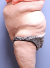 Panniculectomy