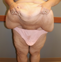 Panniculectomy
