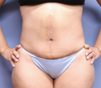 Tummy Tuck