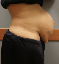 Tummy Tuck