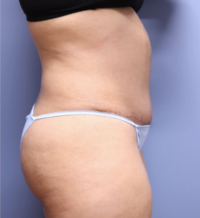 Tummy Tuck