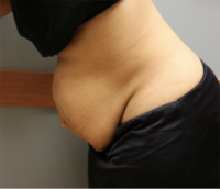 Tummy Tuck