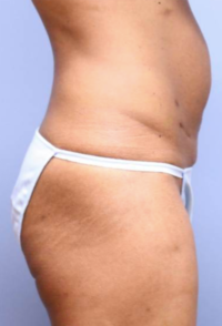 Tummy Tuck