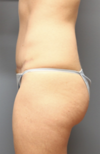 Tummy Tuck