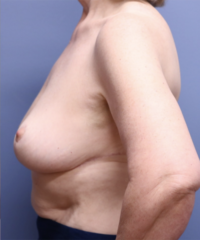 Breast Reduction