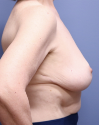 Breast Reduction