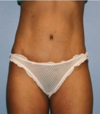 Tummy Tuck