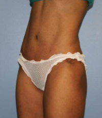 Tummy Tuck