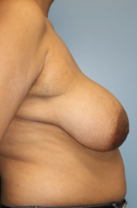 Breast Reduction