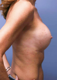 Breast Augmentation