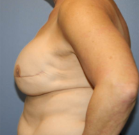Skin Sparing Reconstruction