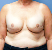 Skin Sparing Reconstruction