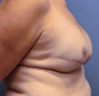Skin Sparing Reconstruction