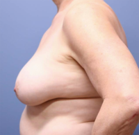 Skin Sparing Reconstruction