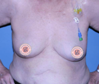 Oncoplastic Breast Reconstruction