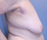 Oncoplastic Breast Reconstruction