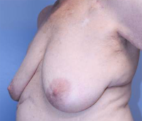 Oncoplastic Breast Reconstruction