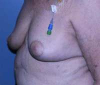 Oncoplastic Breast Reconstruction