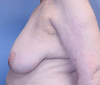 Oncoplastic Breast Reconstruction