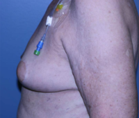 Oncoplastic Breast Reconstruction