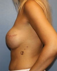 Skin Sparing Reconstruction