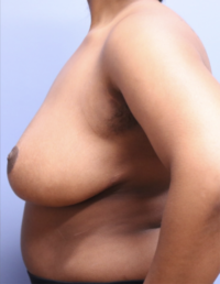 Breast Reduction