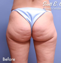 Cellulite Removal