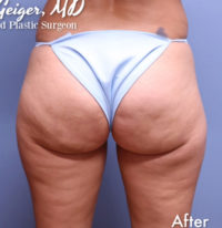 Cellulite Removal