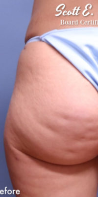 Cellulite Removal