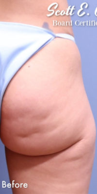 Cellulite Removal