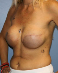 Skin Sparing Reconstruction