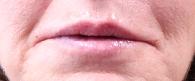 After Lip Augmentation W/ Filler