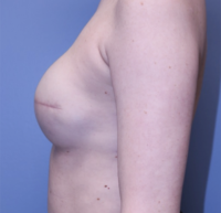 Skin Sparing Reconstruction
