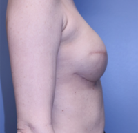 Skin Sparing Reconstruction