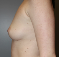 Skin Sparing Reconstruction