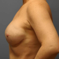 Nipple Sparing Reconstruction