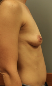 Nipple Sparing Reconstruction