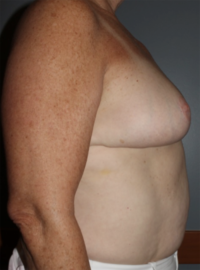 Breast Reduction