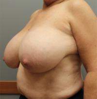 Breast Reduction