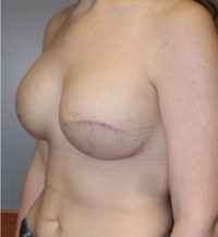 Skin Sparing Reconstruction