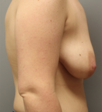 Skin Sparing Reconstruction